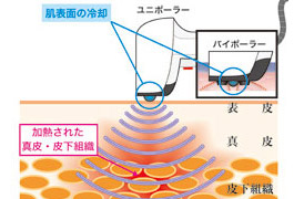 茨城県龍ヶ崎・牛久 痩身 痩身専門サロン優貴 サーモシェイプDeep